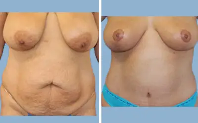 Before and After